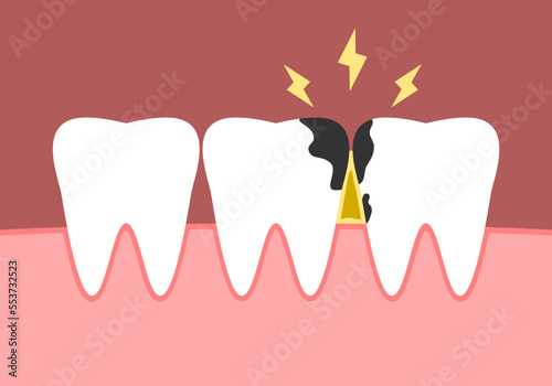 Tooth decay stains food particles on gum in mouth with toothache yellow spark bolt dental cartoon character icon flat vector design.