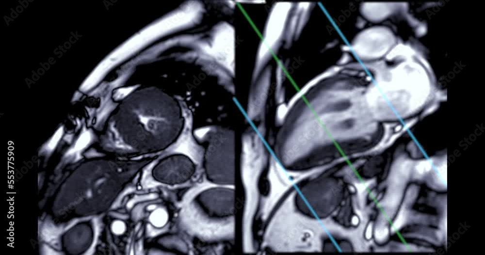 MRI heart or Cardiac MRI ( resonance imaging ) of heart in