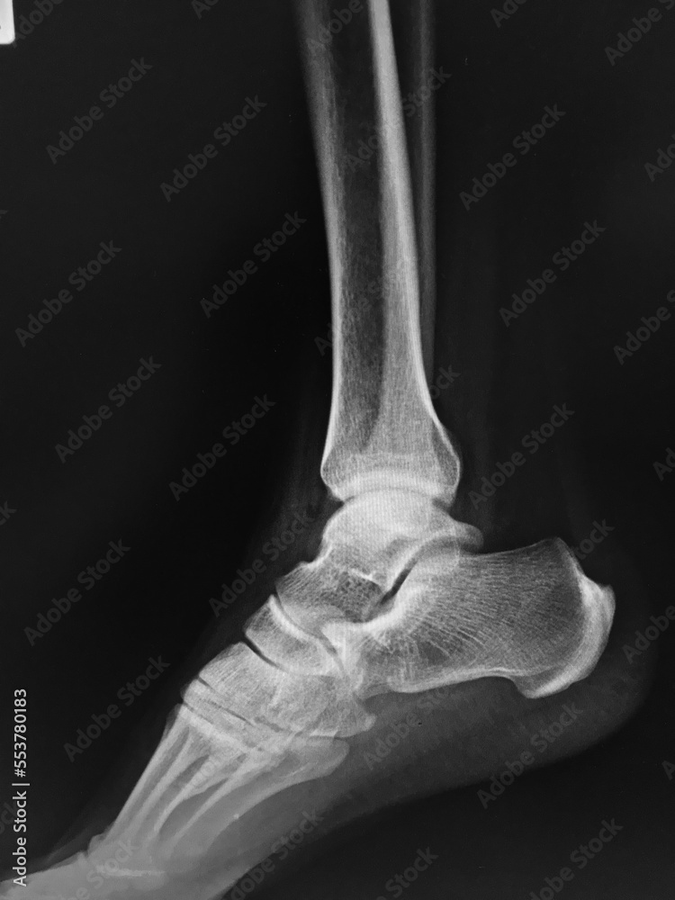 Film x-ray both foot bone