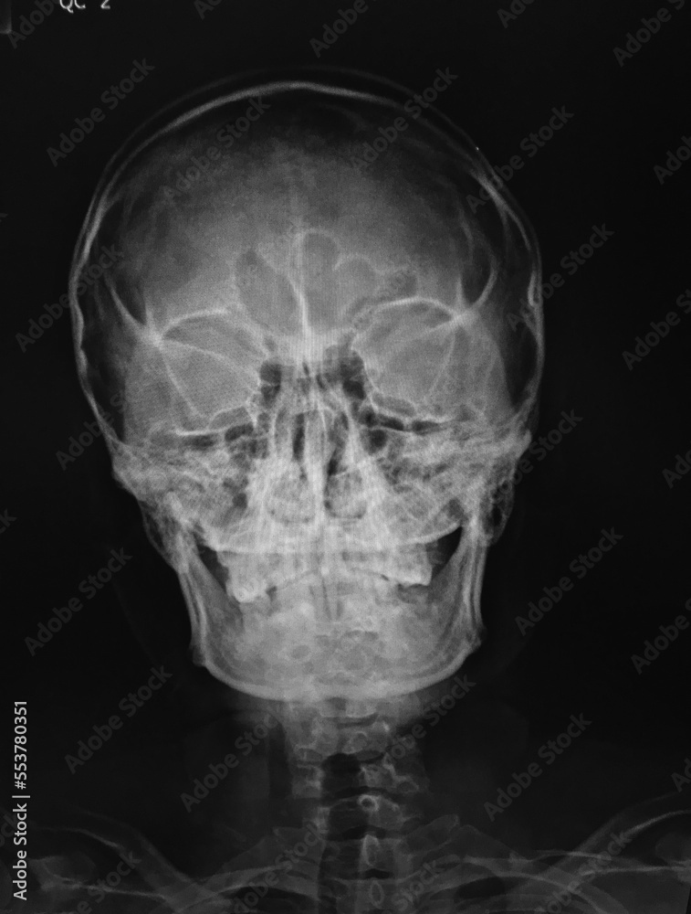 x ray image of skull AP x ray image of skull AP