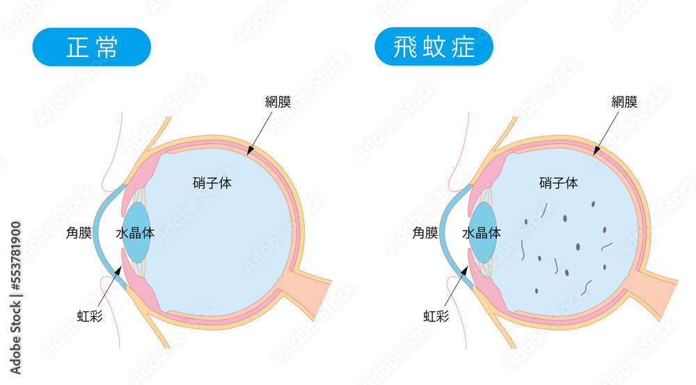 Naklejka premium 正常な目と飛蚊症の目の断面