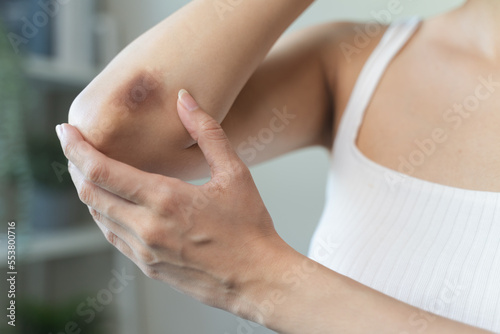 woman get injured and have bruised on her arm.