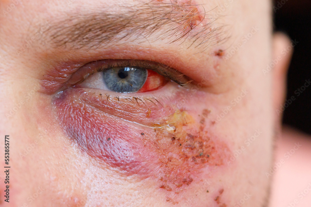 Fototapeta premium Purple hematoma under the eye of a man damaged with blood