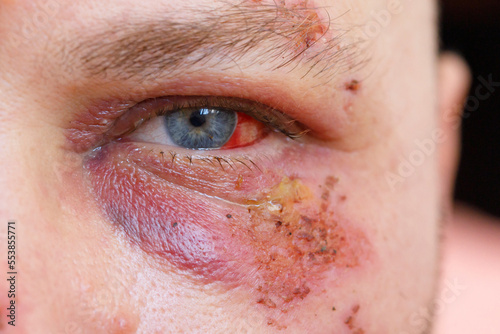 Purple hematoma under the eye of a man damaged with blood photo