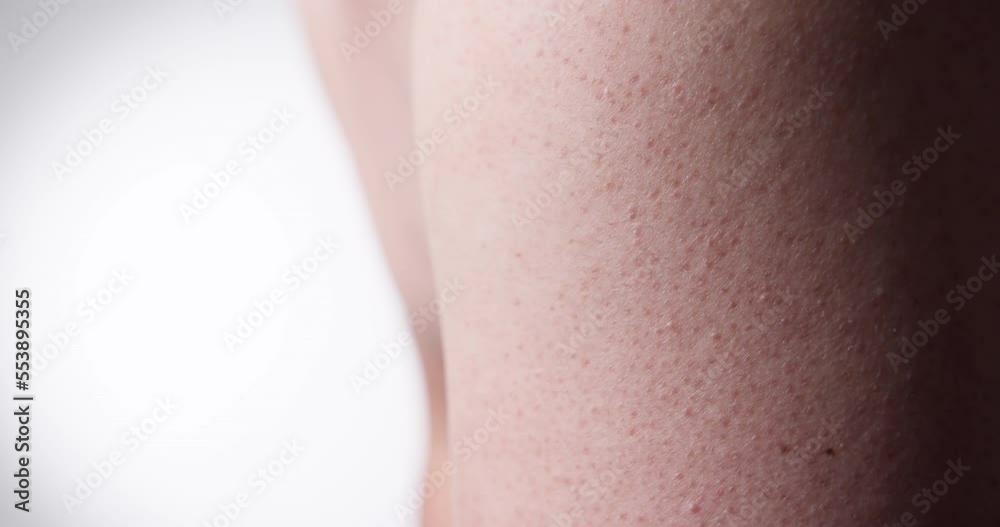 Keratosis Pilaris (KP) a skin problem on upper arm. Slow motion Keratosis Pilaris (KP) a skin problem on upper arm. Slow motion