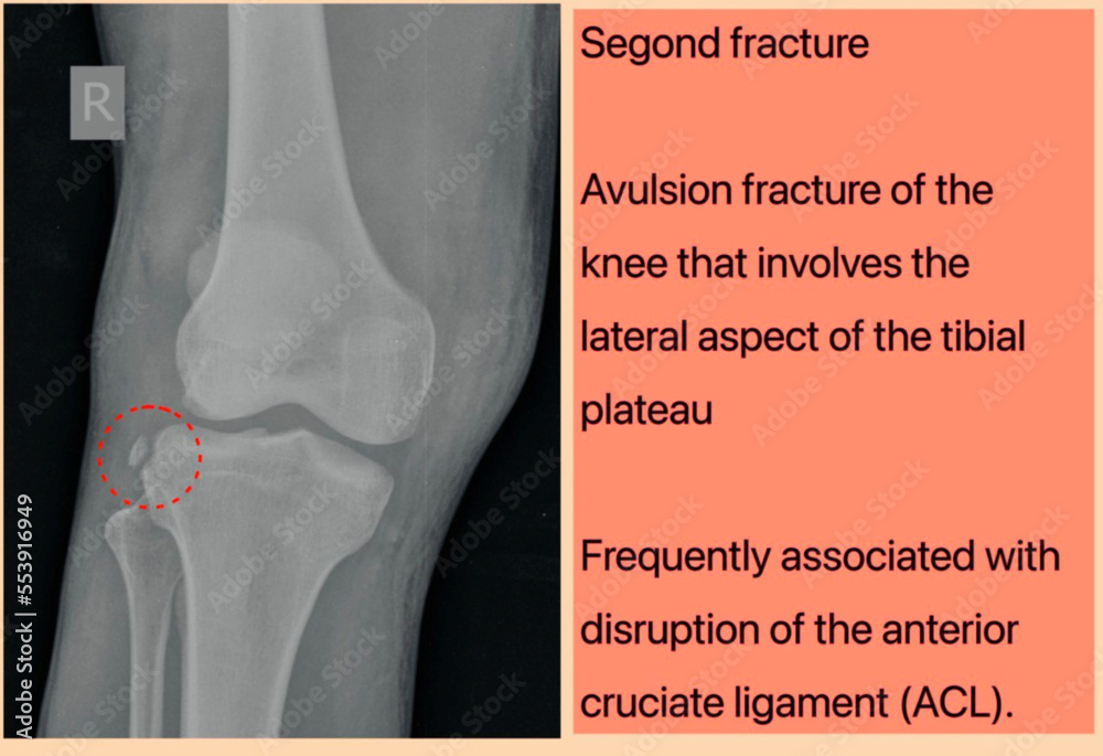Segond fracture knee Xray., Segond fracture is an avulsion fracture of