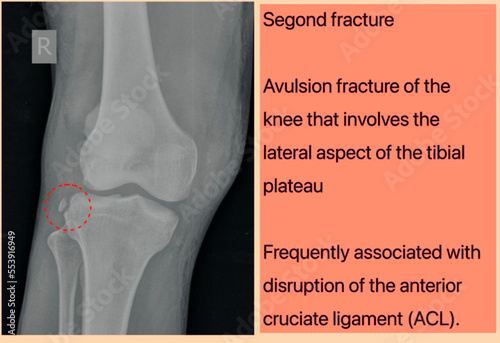 Segond fracture knee X-ray., Segond fracture is an avulsion fracture of the knee that involves the lateral aspect of the tibial plateau photo