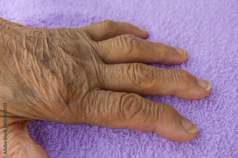Fototapeta premium hand with arthritis on a purple background. inflammation hand in the elderly