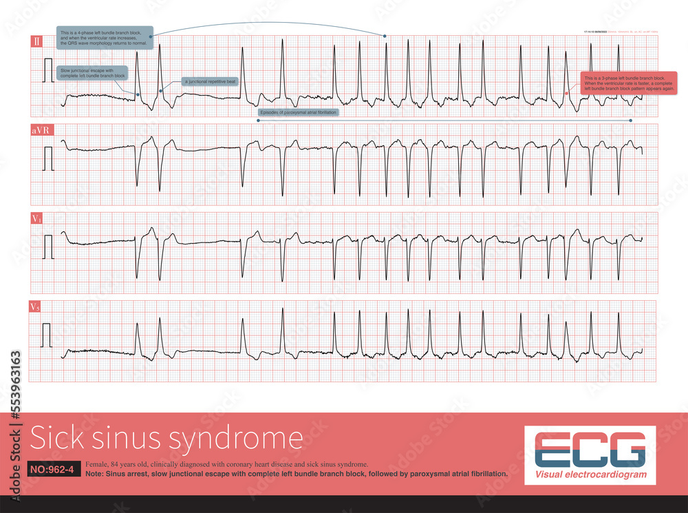 Sinus arrest, slow junctional escape with complete left bundle branch