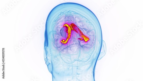 3D medical animation of a man's lateral ventricle photo