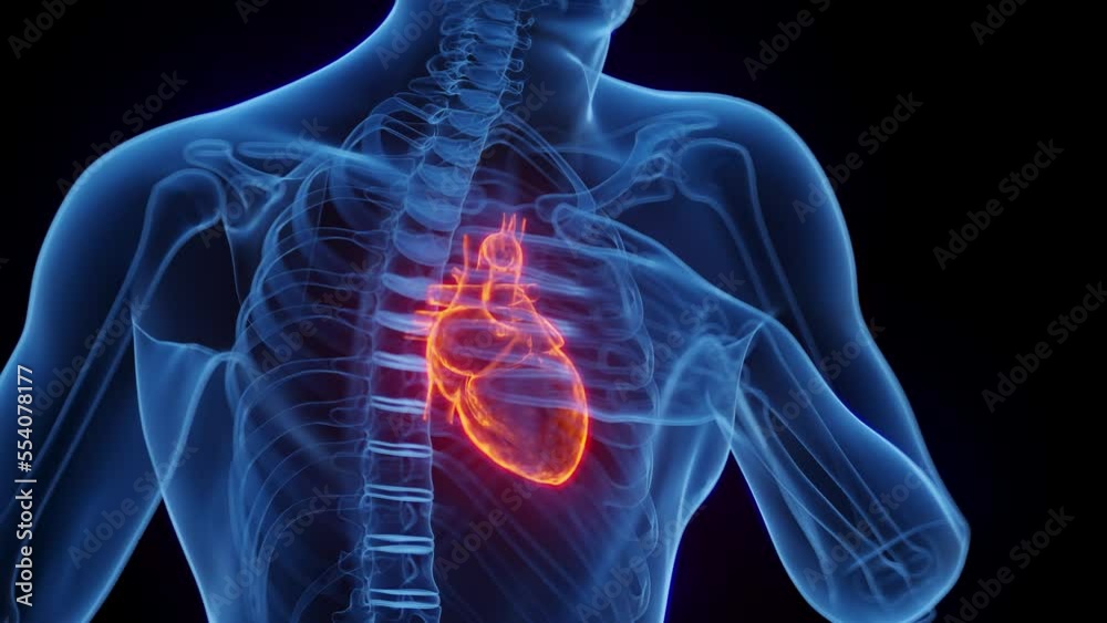 3D medical animation of a man having a heart attack