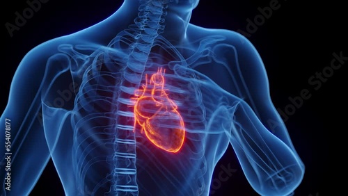 3D medical animation of a man having a heart attack