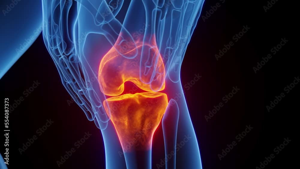 3D medical animation of a man experiencing knee pain 3D medical animation of a man experiencing knee pain