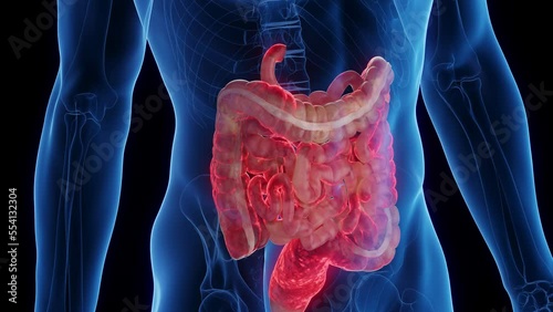 3D medical animation of a man's intestines affected by crohn's disease