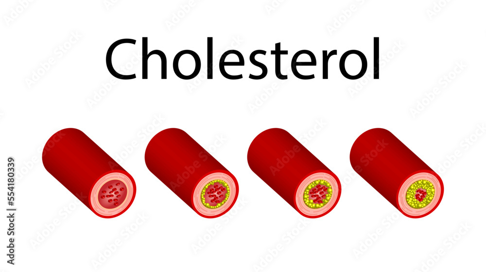 Cholesterol plaque buildup in artery stages. Process of cholesterol