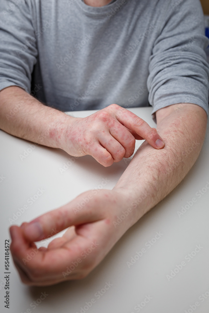 Patient showing red itchy rash on hands and arms. Dermatitis, eczema