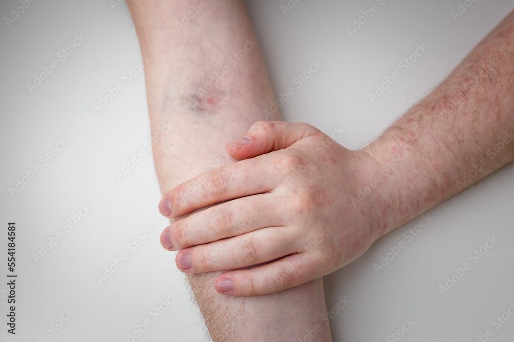 Male arm with syringe injection mark from vaccine. Reddening reaction and rash by effect of vaccinated patient. Hands top view Male arm with syringe injection mark from vaccine. Reddening reaction and rash by effect of vaccinated patient. Hands top view