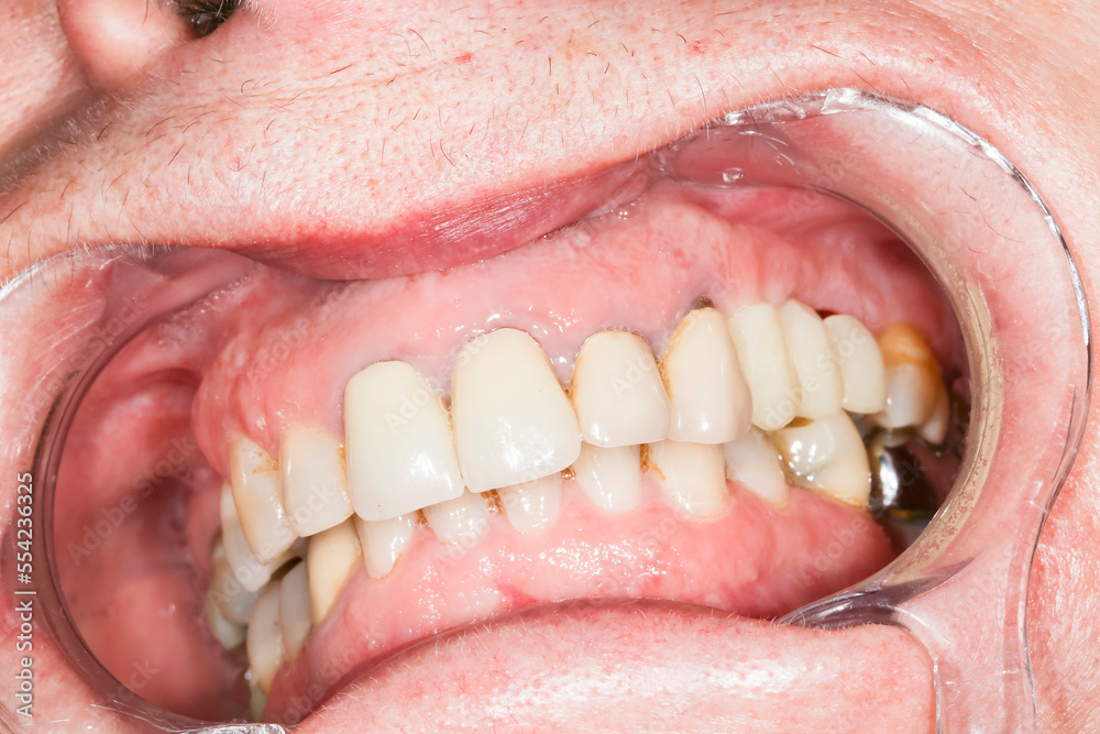Fototapeta premium Close up macro shot of interior of mouth and fillings and crowns on teeth, with tartar. Need teeth whitening