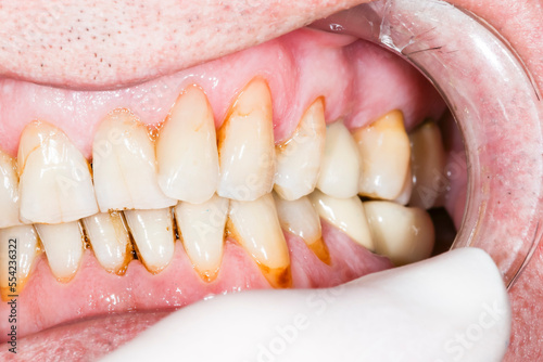 Close up macro shot of interior of mouth and fillings and crowns on teeth, with tartar. Need teeth whitening