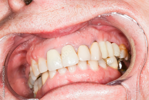 Close up macro shot of interior of mouth and fillings and crowns on teeth, with tartar. Need teeth whitening