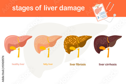 Stage vector illustration of liver damage  From Healthy Liver to Fatty liver.Liver fibrosis to cirrhosis  flat design  healthy concept