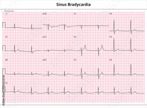 ECG Sinus Bradycardia - ECG Athlete - 12 Leads ECG Paper