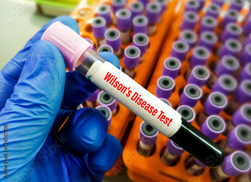 Blood sample for wilson's disease test. ATP7B. 