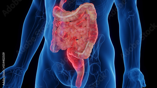 Photo 3D medical illustration of a man's intestines affected by Crohn's disease