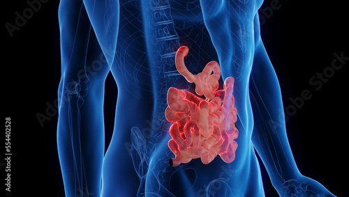 Obraz na plátně 3D medical illustration of a man's inflamed small intestine