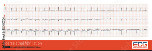 Sometimes, coarse atrial fibrillation is easily misdiagnosed as atrial flutter, but their shape, amplitude and frequency are almost beat by beat changes. photo