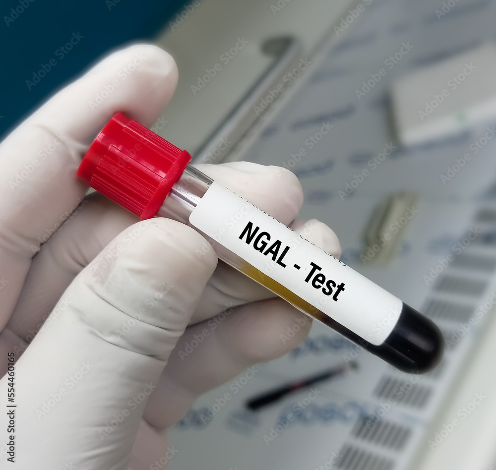 Ngtl Lab Blood sample for NGAL(Neutrophil gelatinase-associated lipocalin) test ...