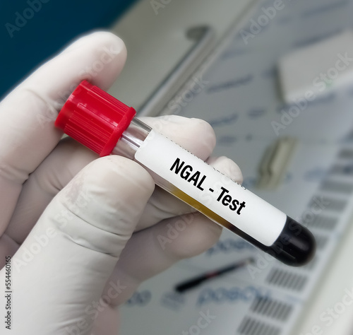 Blood sample for NGAL(Neutrophil gelatinase-associated lipocalin) test, to diagnosis of acute kidney injury. photo