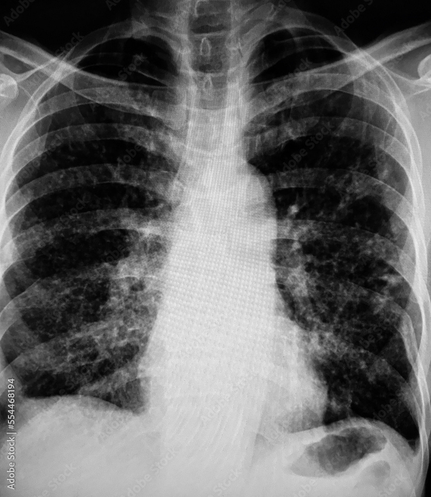 X-Ray Image Of Human Chest for a medical diagnosis X-Ray Image Of Human Chest for a medical diagnosis