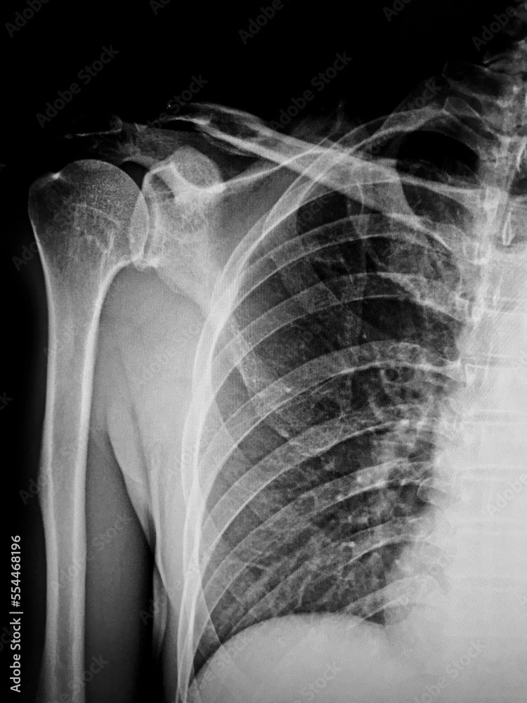 X-Ray Image Of Human Chest for a medical diagnosis X-Ray Image Of Human Chest for a medical diagnosis