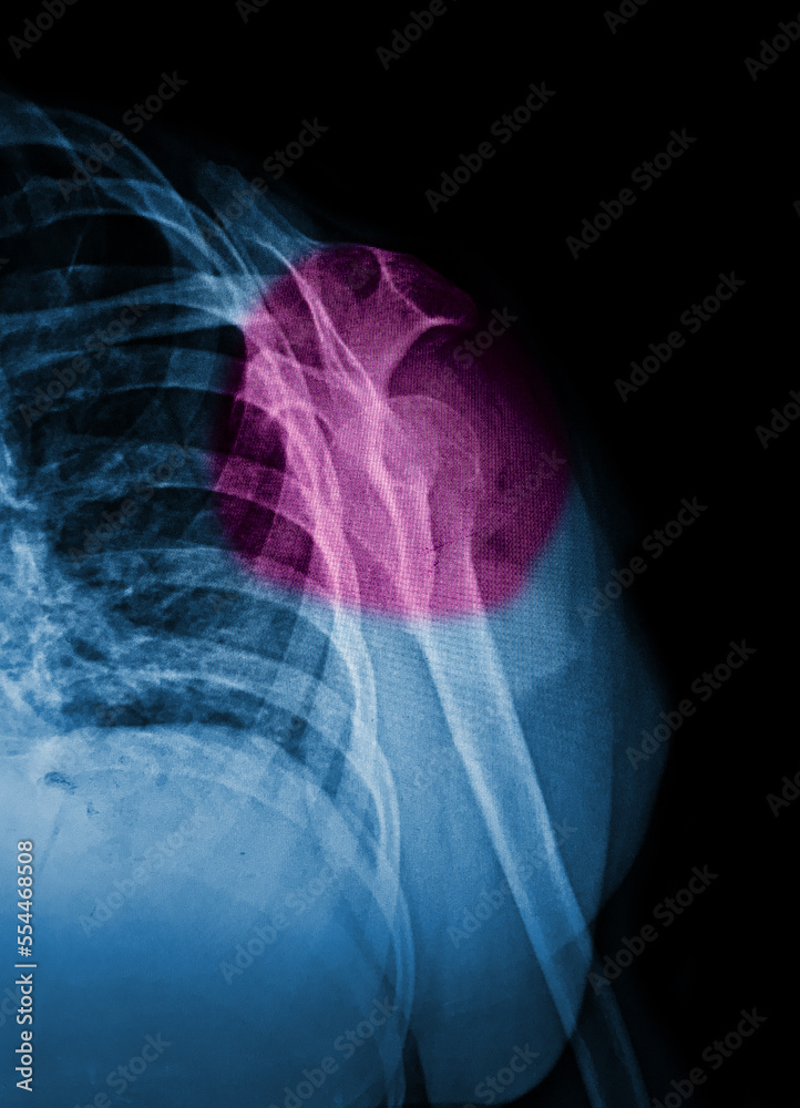 film xray fracture at neck of humerus ( arm bone ) Stock Photo Adobe