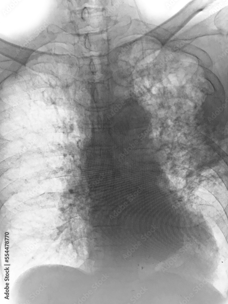 "Pulmonary tuberculosis" Film chest xray show interstitial infiltration both lung Stock Photo