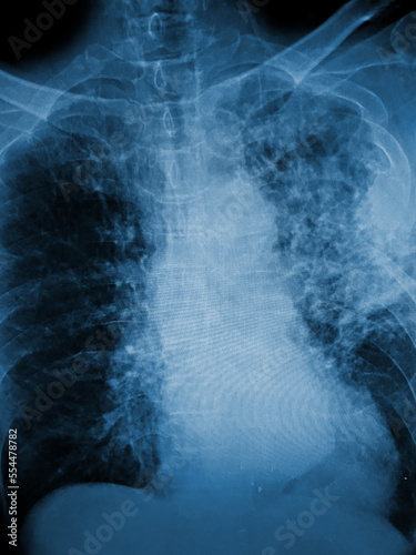 "Pulmonary tuberculosis" Film chest x-ray show interstitial infiltration both lung