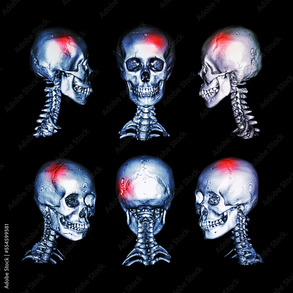 CT scan and 3D image of head and cervical spine . Use this image for