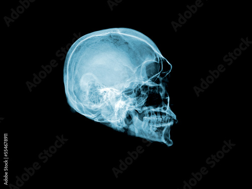 x ray of human skull
