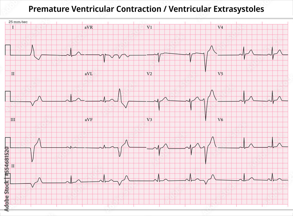 ECG PVC (Premature Ventricular Contractions) - ECG VES (Ventricular ...