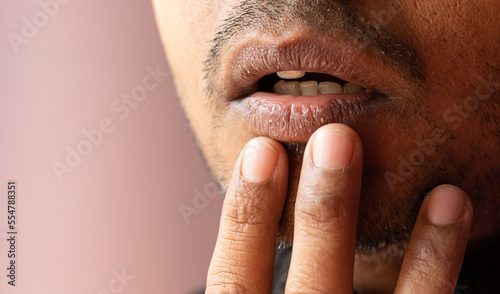 Dry lips problem