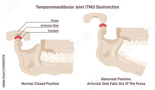 Temporomandibular joint disorder or TMJ. Condition affecting