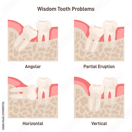 Wisdom tooth problems set. Impaction, wisdom teeth growing with wrong