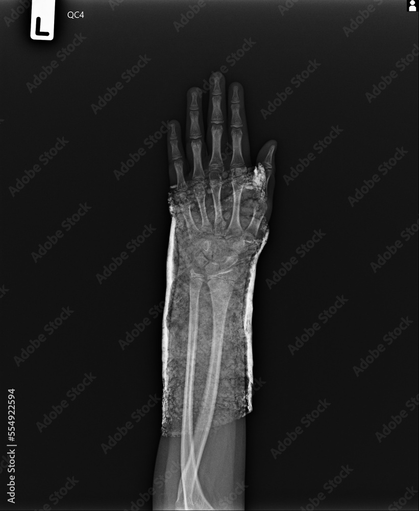 Film x-ray AP Forearm on Slap Film x-ray AP Forearm on Slap