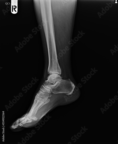 Film x-ray of  ankle . Lateral view