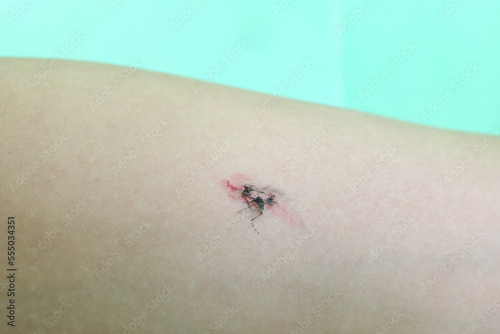 Selective focus of a crushed or smashed mosquito on arm with blood.