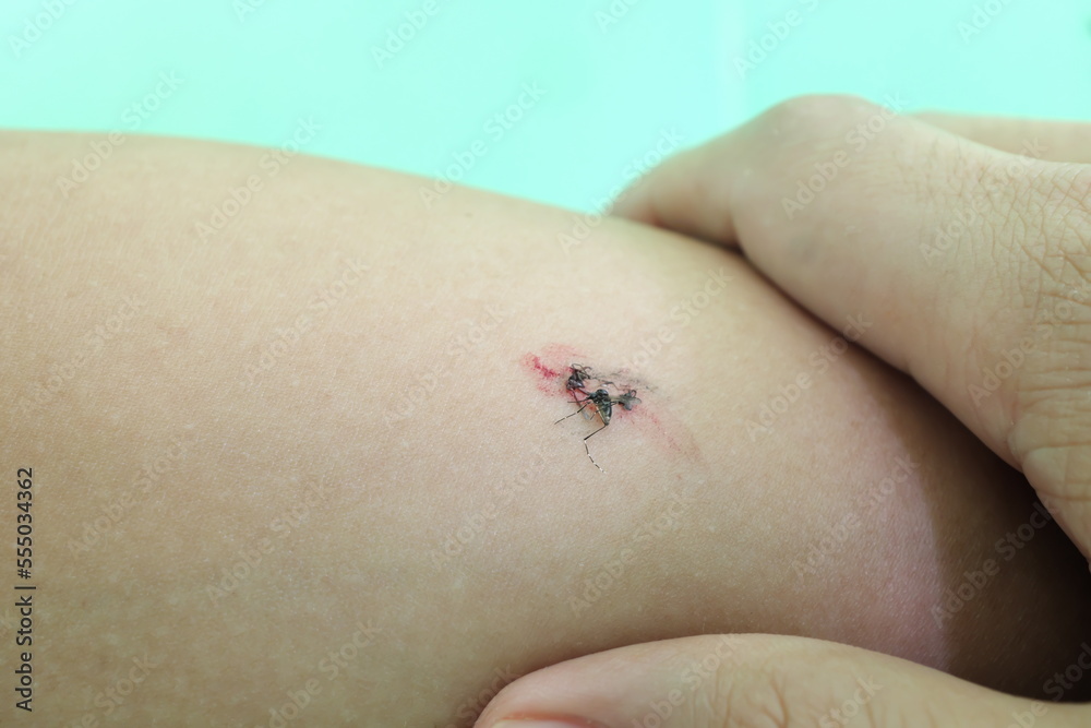 Selective focus of a crushed or smashed mosquito on arm with blood.