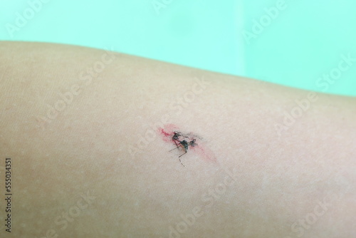 Obraz na płótnie Selective focus of a crushed or smashed mosquito on arm with blood. w salonie