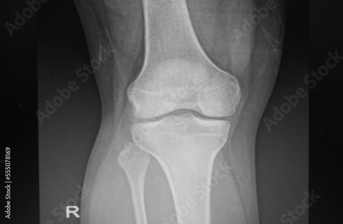 X-ray image of right human knee