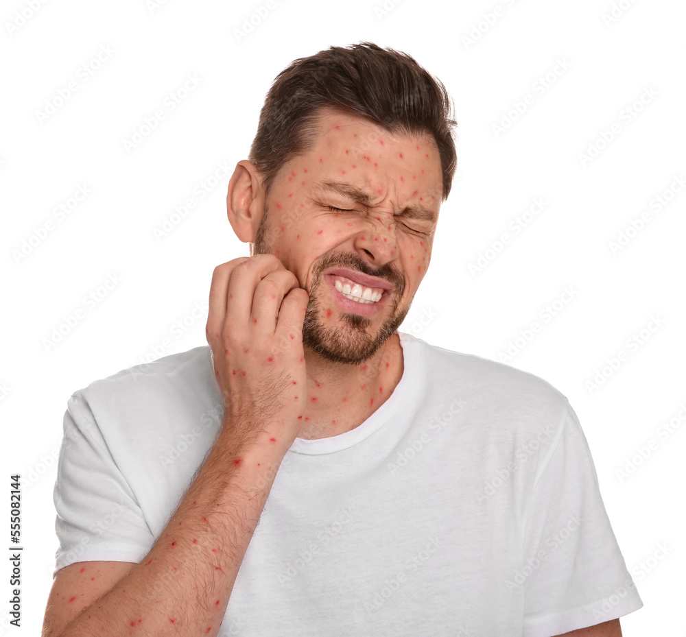 Man with rash suffering from monkeypox virus on white background Man with rash suffering from monkeypox virus on white background